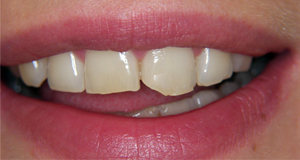 Художественна реставрация зубов композитами: ДО